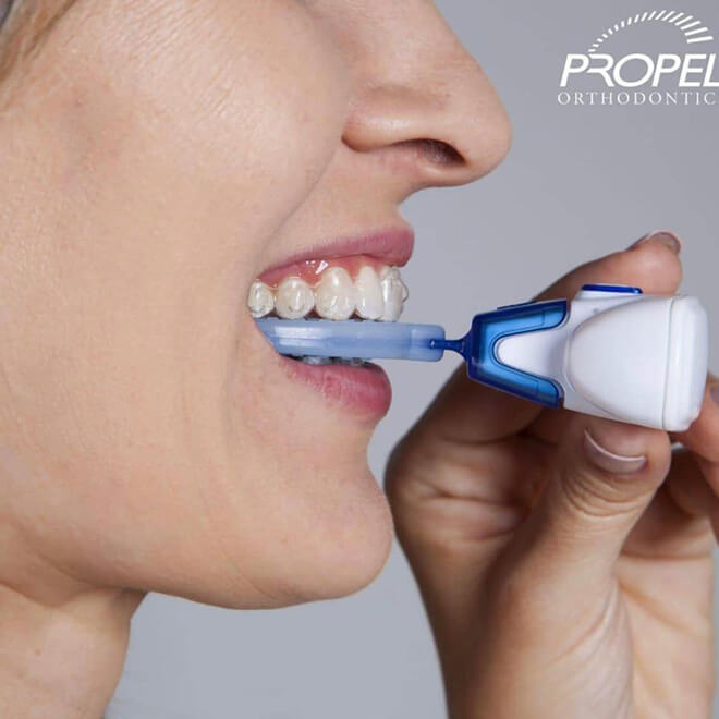 Accelerated Treatment 1 What is the propel vpro5®?