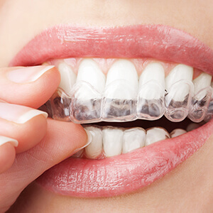 Free In-Office Consultation 9 Clear aligners