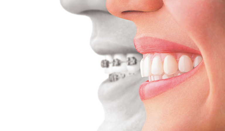 Braces Vs. Invisalign 5 Blog 134