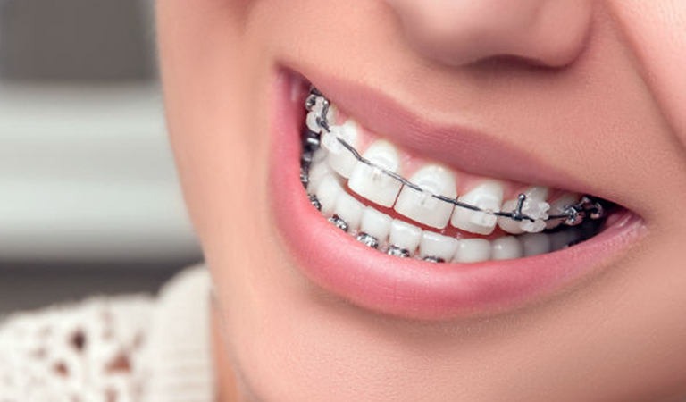 Advantages Of Clear Braces In Orlando, Fl 1 Blog 97