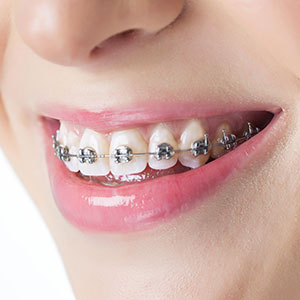 Free In-Office Consultation 8 Traditional braces
