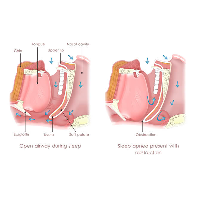 Sleep Apnea &Amp; Tmj 4 Tmj And Sleep Apnea How sleep apnea and tmj are connected