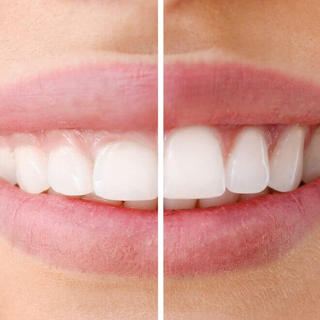 Smile Makeover Dentist 3 Smile Makeover Dentist Laser gingival recontouring