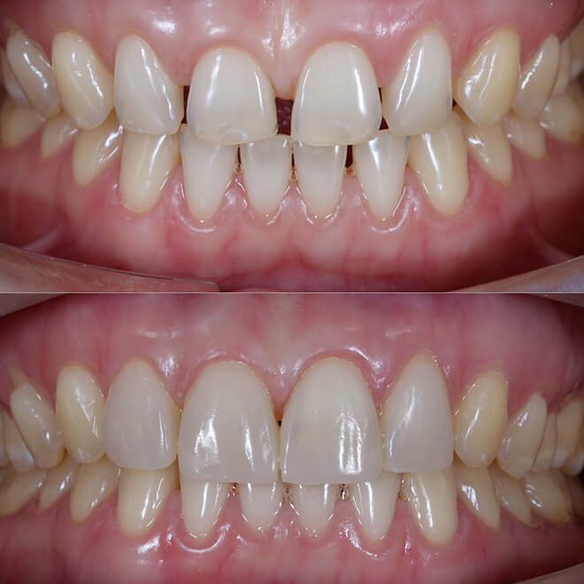 Smile Makeover Dentist 2 Smile Makeover Dentist Enameloplasty - best smile makeover dentist