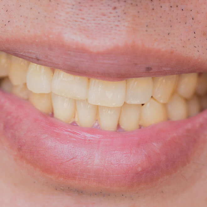 Teeth Whitening 1 Teeth Whitening Why are my teeth stained?