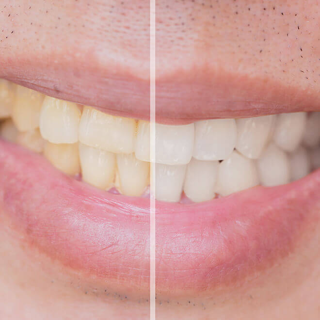 Teeth Whitening 2 Teeth Whitening How does teeth whitening treatment work?
