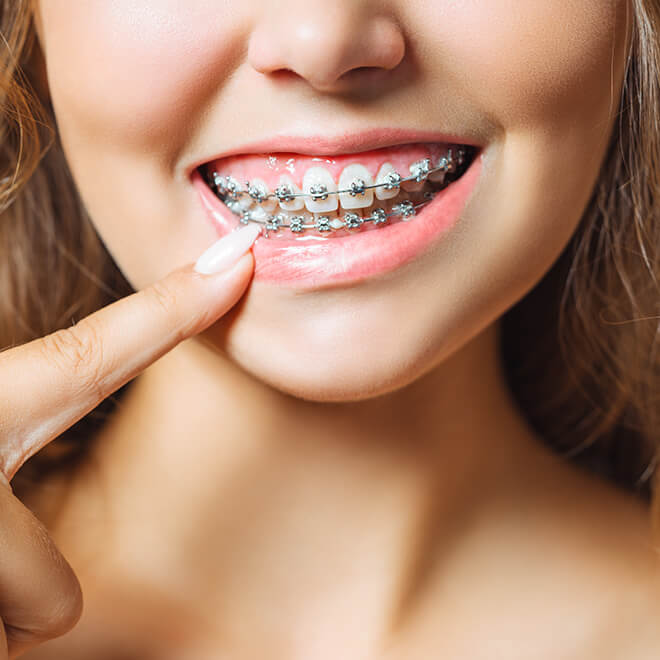 Types Of Braces 2 Types Of Braces Self-tightening braces