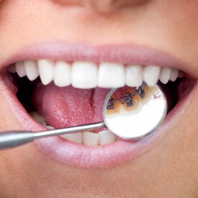 Types Of Braces 5 Types Of Braces Behind the teeth inbraces