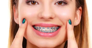 Brace computer 3d braces